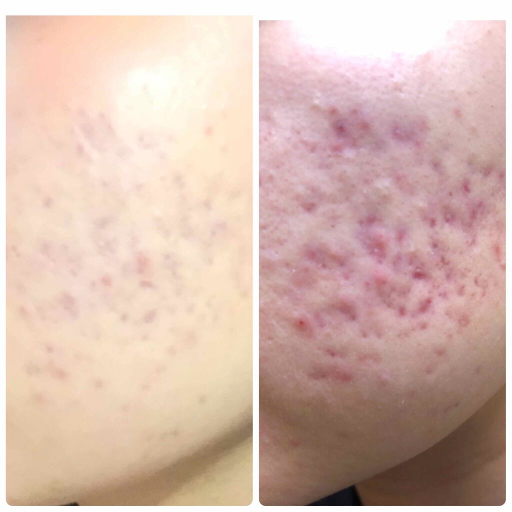 AC クレンジングジェル/NOV/クレンジングジェルを使ったクチコミ（2枚目）