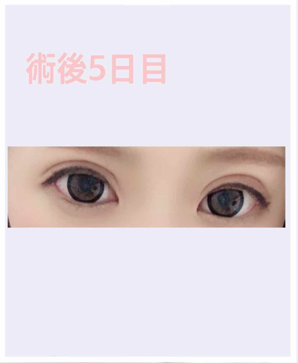 momo on LIPS 「🌟🌟🌟二重埋没4点留め🌟🌟🌟術後5日目の様子です。右目が若干腫..」(1枚目)