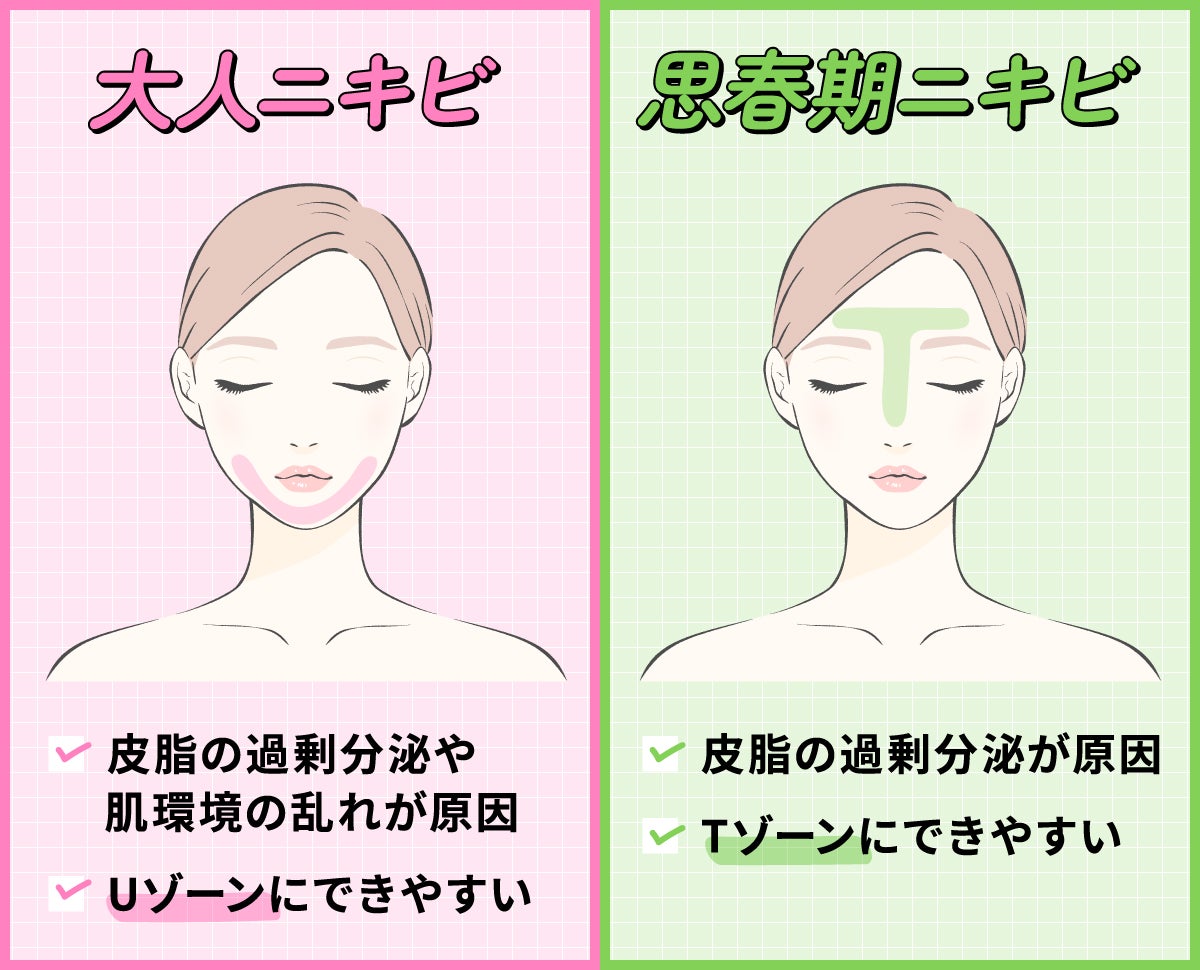 大人ニキビは皮脂の過剰分泌や肌環境の乱れが原因でUゾーンにできやすい。思春期ニキビは皮脂の過剰分泌が原因でTゾーンにできやすい。