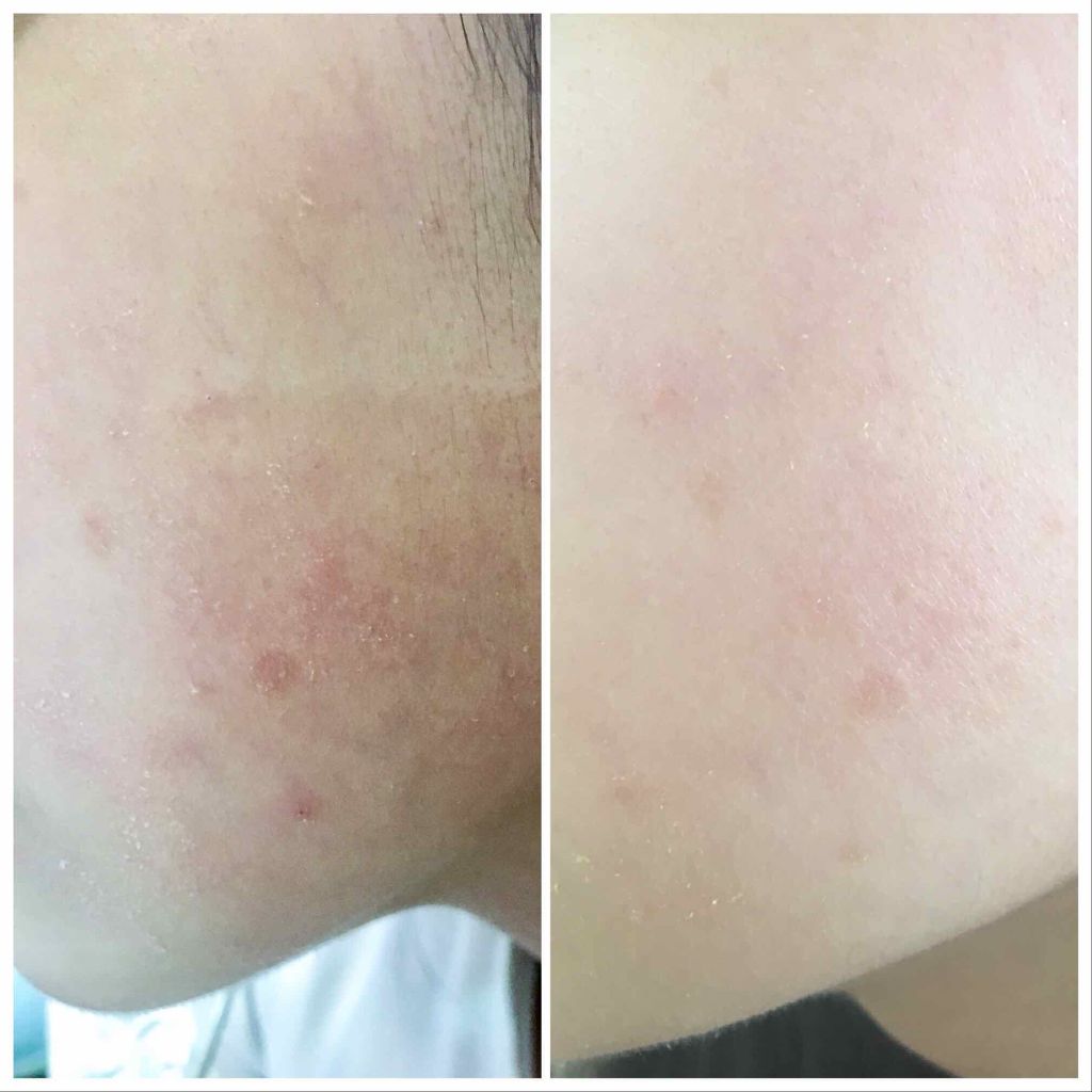 薬用 しみ 集中対策 美容液/メラノCC/美容液を使ったクチコミ（2枚目）