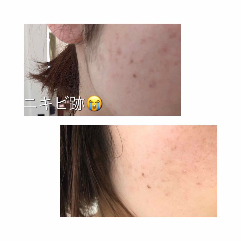 FASIZ IPL脱毛器/FASIZ/家庭用脱毛器を使ったクチコミ(2枚目)