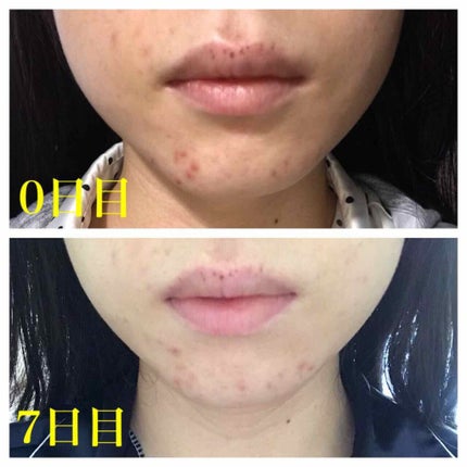 ファイバーフォーム/ルナメアAC/洗顔フォームを使ったクチコミ(4枚目)