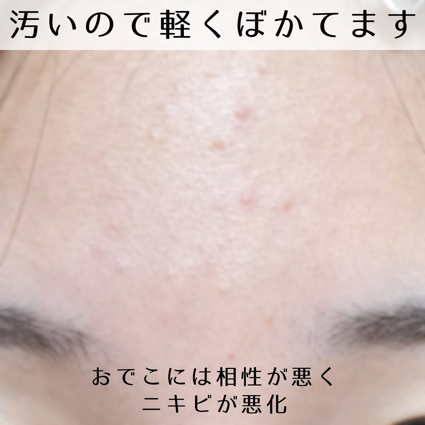 ダーマセプトRX AZAセラム/ダーマセプトRX/美容液を使ったクチコミ(5枚目)