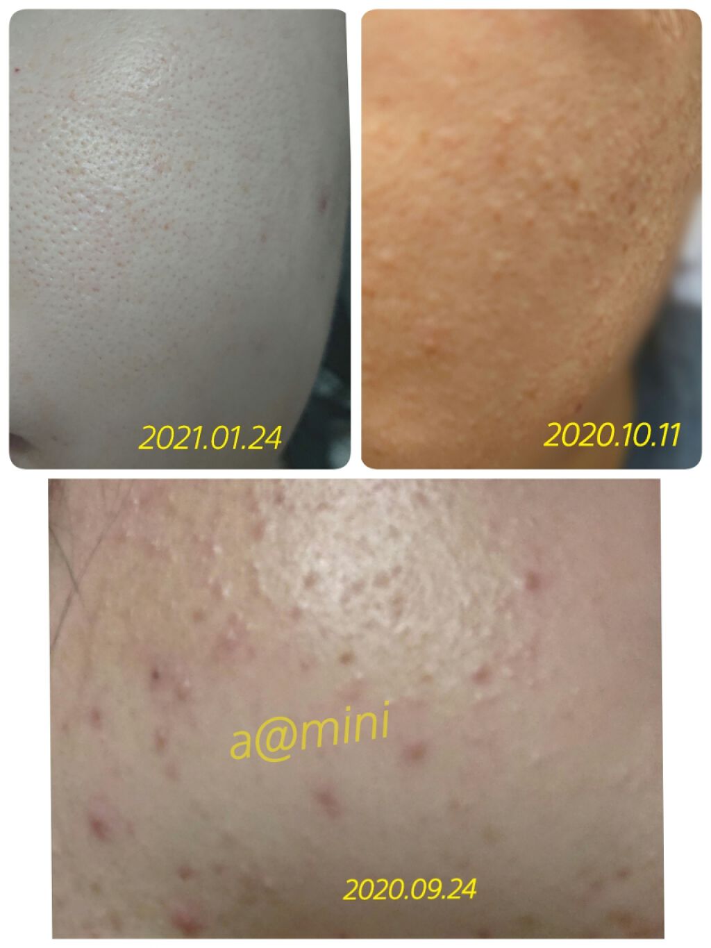 プラセンタエキス原液/fracora/美容液を使ったクチコミ（3枚目）