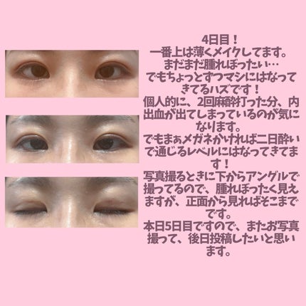 ししっぴ。フォロバはお任せください💕 on LIPS 「二重埋没ダウンタイム途中経過🙌💕こんにちは!ししっぴ。です!初..」(5枚目)