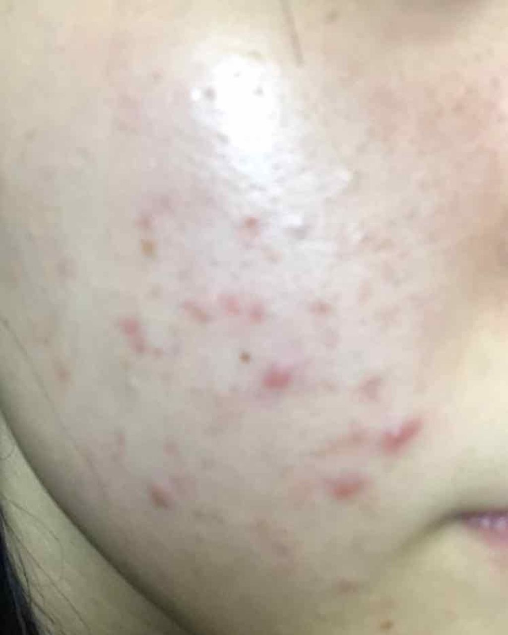 テラマイシン 軟膏(医薬品)/ジョンソン・エンド・ジョンソン/その他を使ったクチコミ（2枚目）