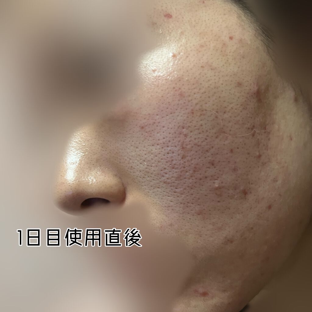 AGE-Rダーマエアショット/MEDICUBE/美顔器・マッサージを使ったクチコミ（3枚目）