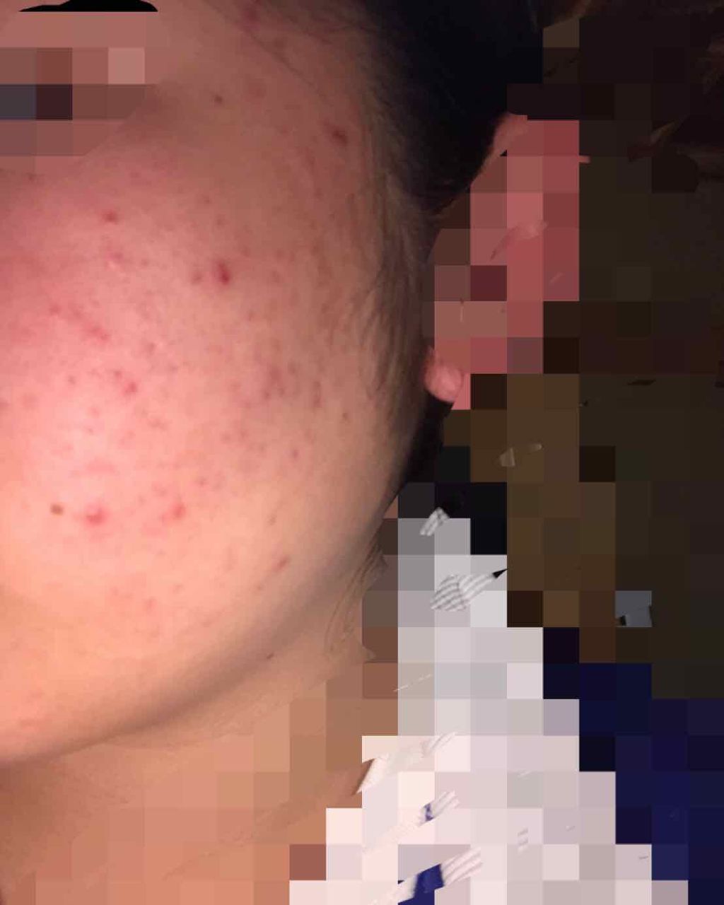 ま な か on LIPS 「ニキビについて悩み相談させてください!!閲覧注意です。にきびが..」(2枚目)