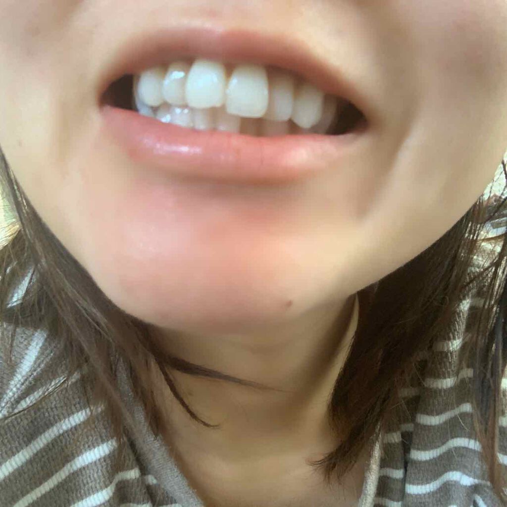 ミュゼホワイトニング 速攻美白 ポリリンキューブ 3個入り/ミュゼホワイトニング/歯磨き粉を使ったクチコミ（1枚目）