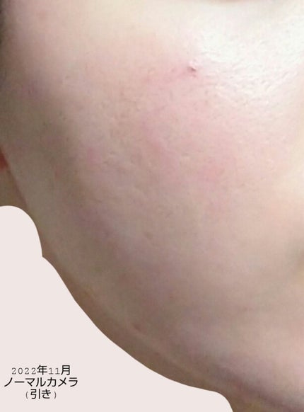 スマートセット/プロアクティブ/スキンケアキットを使ったクチコミ(4枚目)