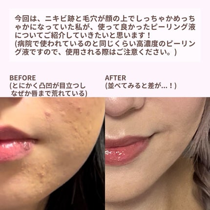 YEOUTH Glucolic Acid 30% Gel Peelのクチコミ「今回は私が定期的に使用している
買ってよかったピーリング液について
ご紹介していきたいと思いま.....」(2枚目)