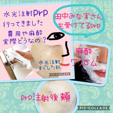 TBC EGF-エクストラエッセンス EXのクチコミ「田中みな実さんもやられてるprp療法実は受けてきました！

prp療法とは、
自分の血液を採っ.....」（1枚目）