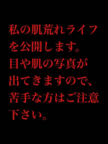 楓@LIPSパートナー on LIPS 「#ニキビスキンケア初投稿です。いきなり黒歴史を公開いたします笑..」(1枚目)