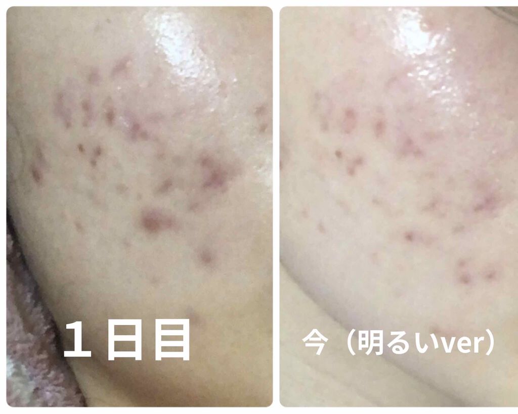 アポスティークリーム(医薬品)/アポスティー/その他を使ったクチコミ(2枚目)