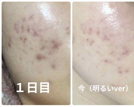 ミノン アミノモイスト 薬用アクネケア ローション/ミノン/化粧水を使ったクチコミ(2枚目)