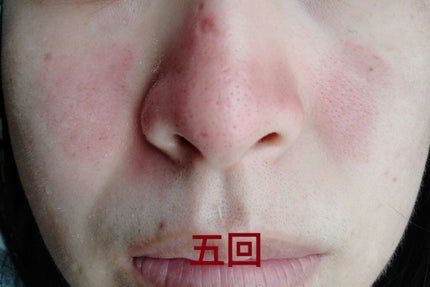 ダーマペン・ダーマスタンプ/MyM/その他スキンケアグッズを使ったクチコミ(1枚目)