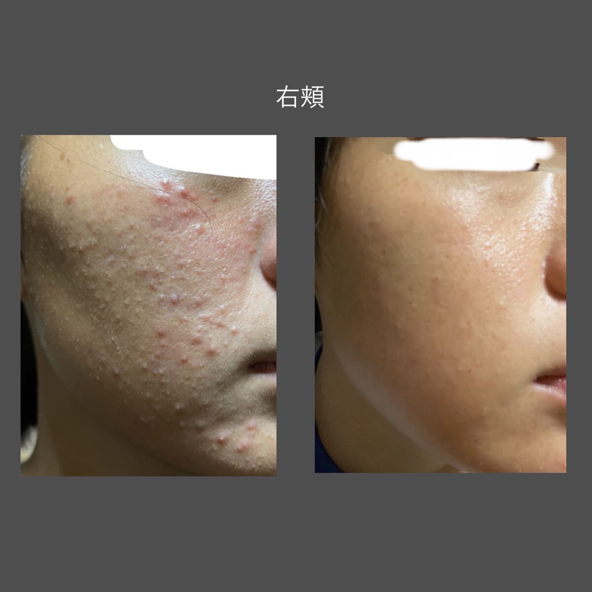 DHC ビタミンＣハードカプセル/DHC/美容サプリメントを使ったクチコミ（3枚目）