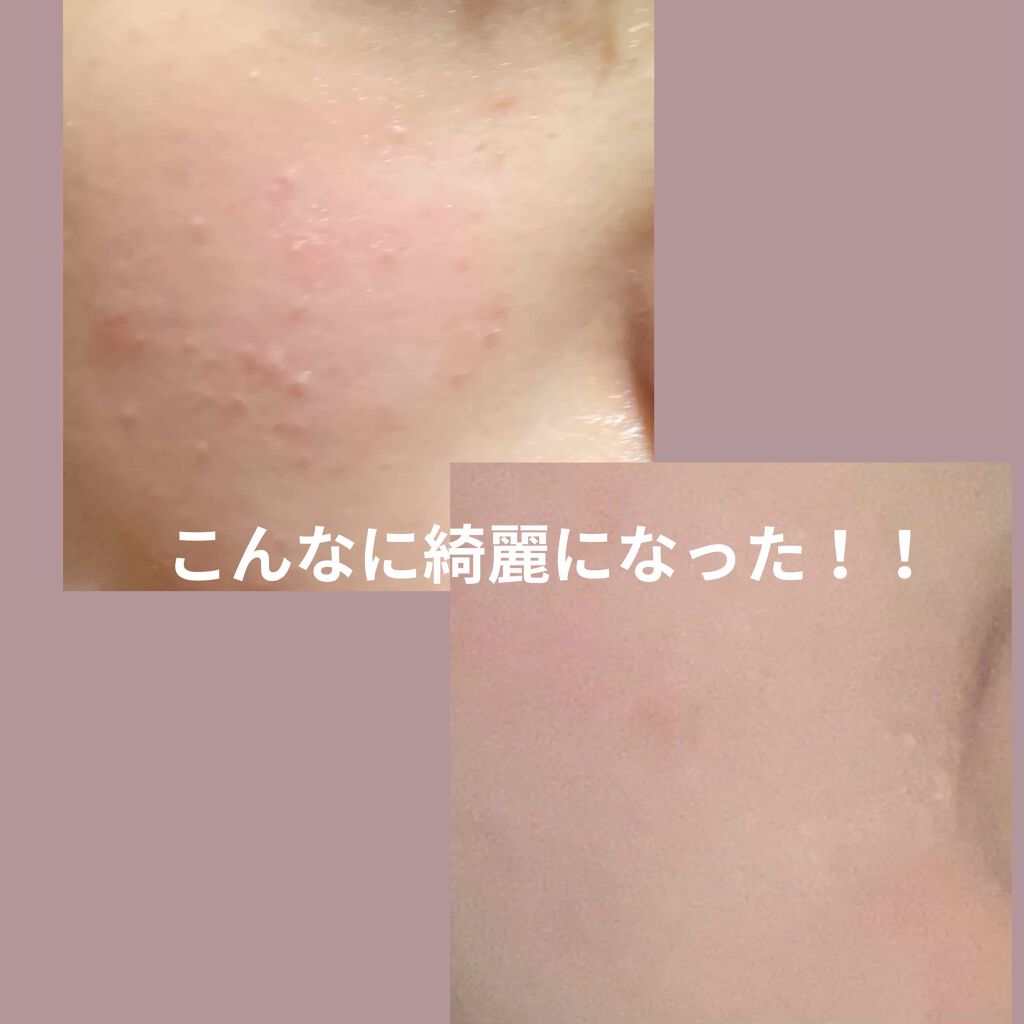 ペアアクネクリームW(医薬品)/ペア/その他を使ったクチコミ(1枚目)