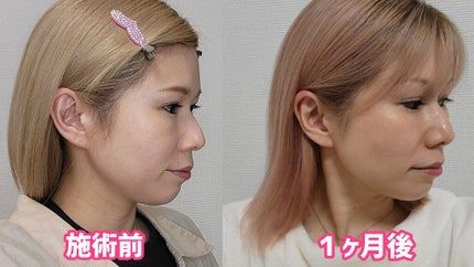 ELFACE/ELFACE/美顔器・マッサージを使ったクチコミ(2枚目)