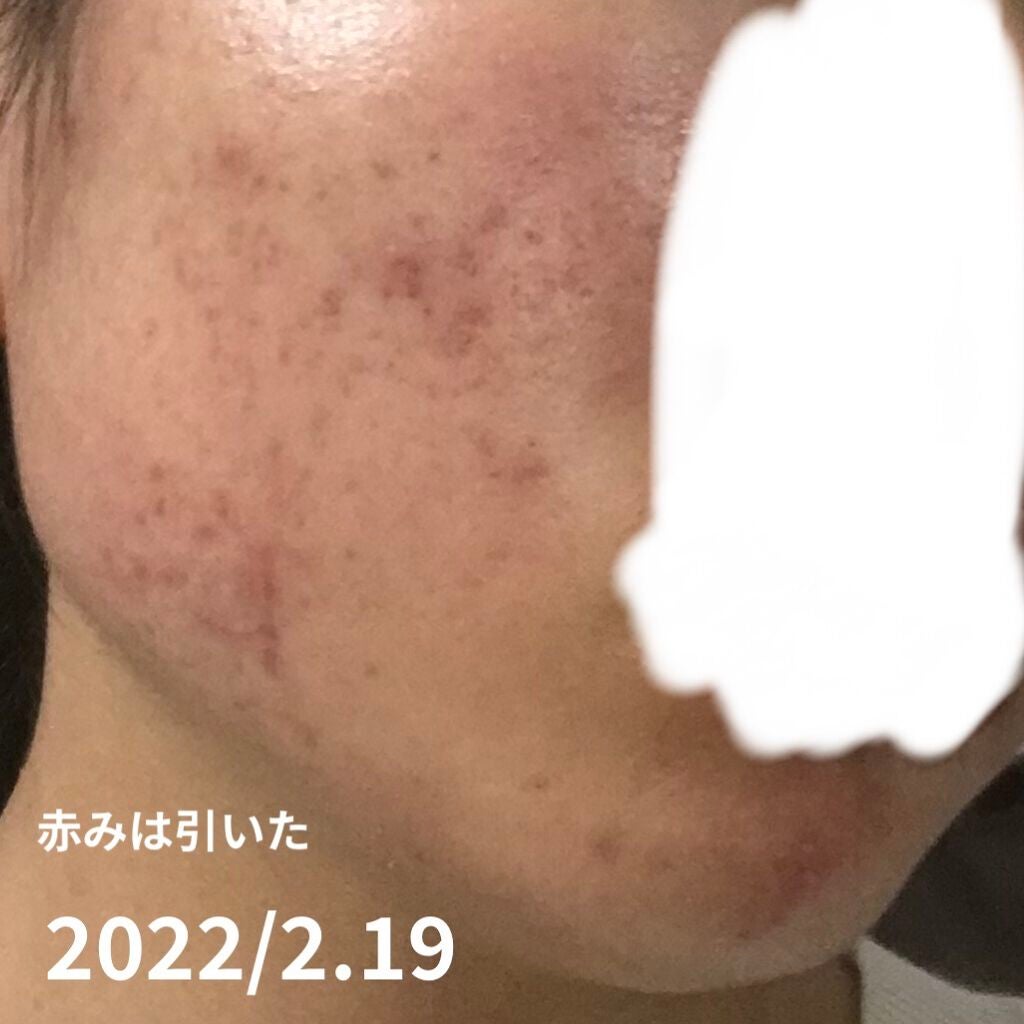 かす子 on LIPS 「脂性肌?の私流❕ニキビ対処法まとめ〈これまで〉中1の時からしこ..」(3枚目)