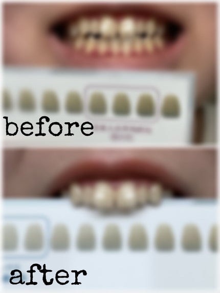 ホワイティエッセンス/MiiS/その他オーラルケアを使ったクチコミ(5枚目)