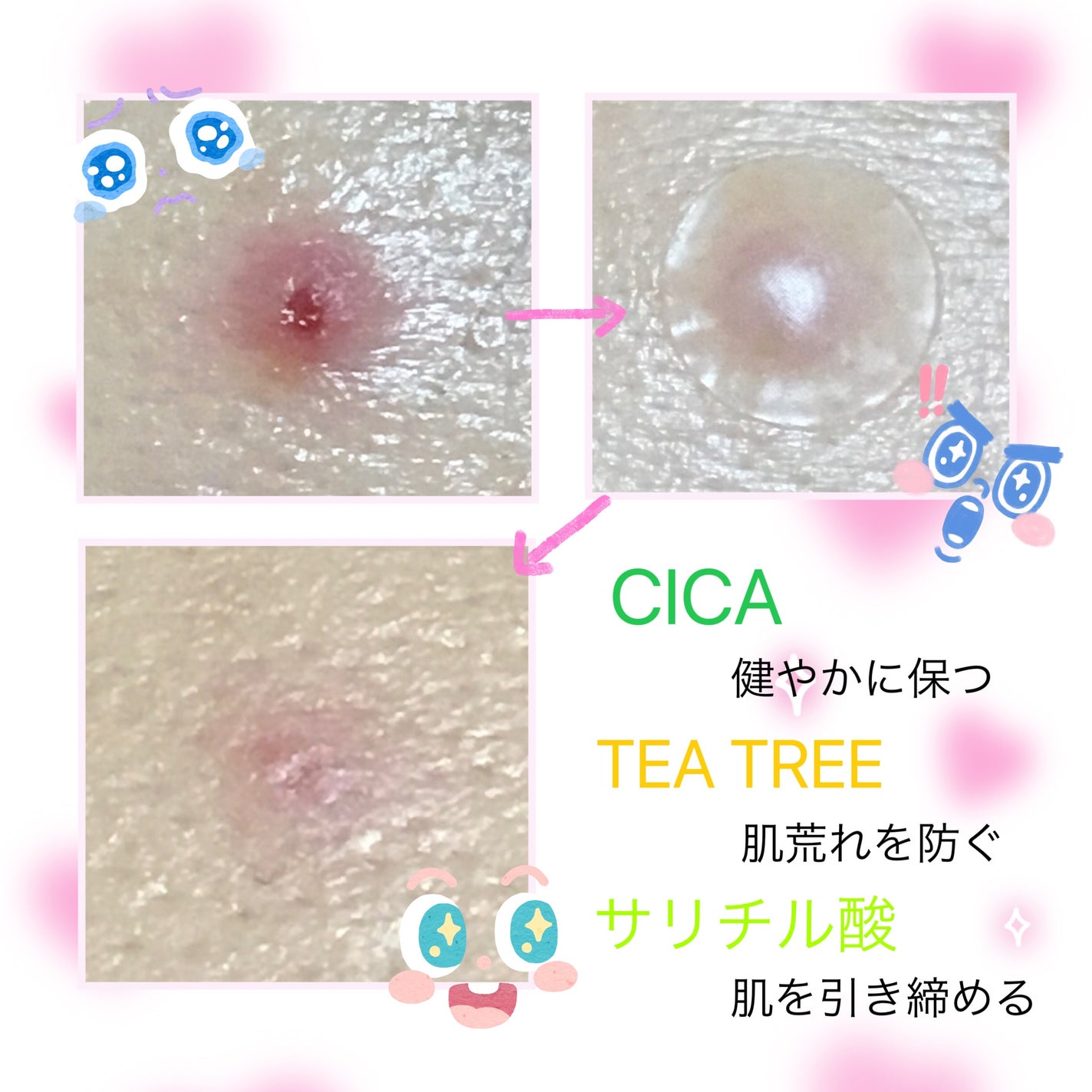 CICAティーツリークリアパッチ+/Angelab/にきびパッチを使ったクチコミ(2枚目)