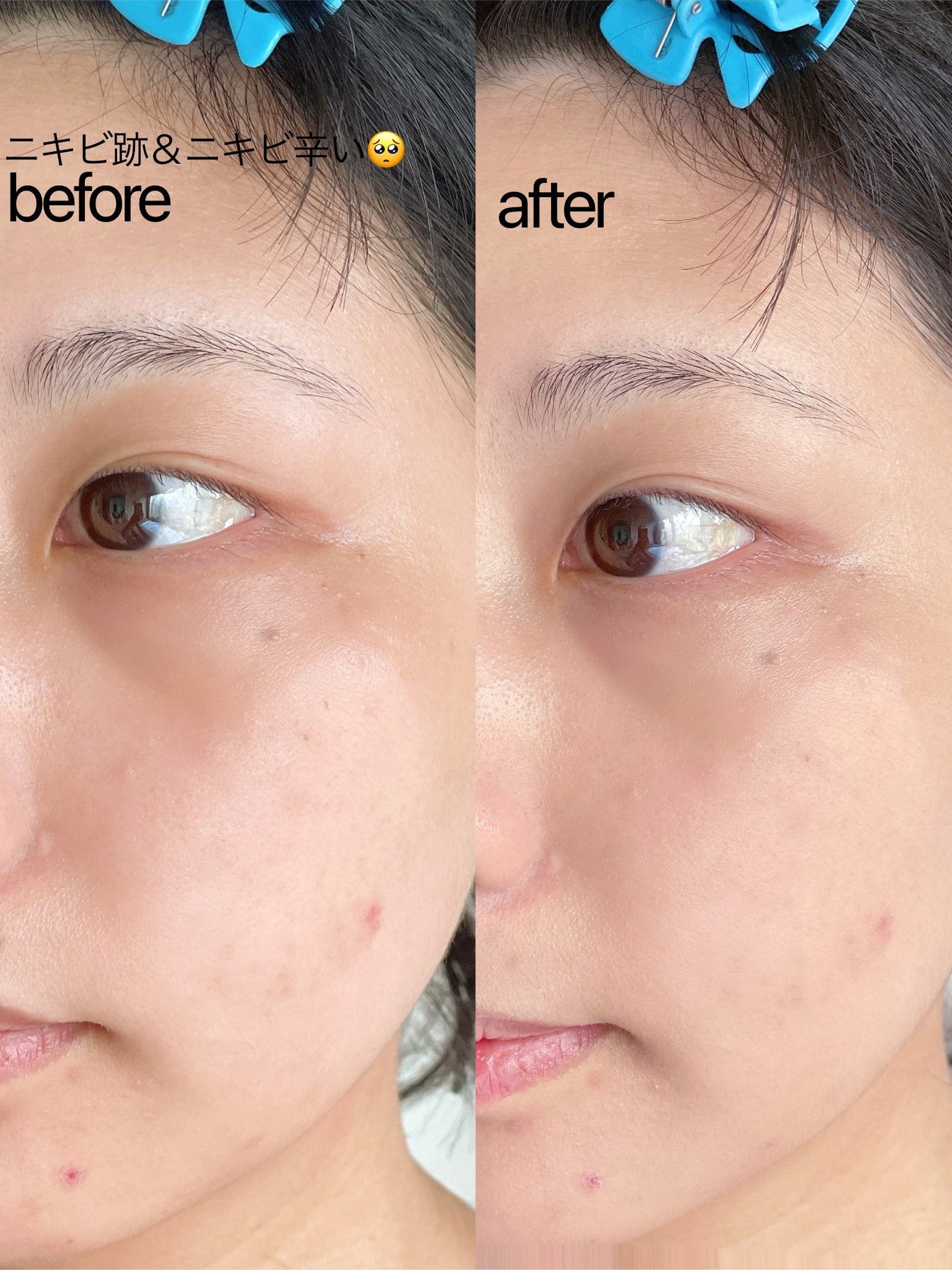 V3 エキサイティングファンデーション/SPICARE/クッションファンデーションを使ったクチコミ(5枚目)