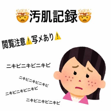 
皆さんお久しぶりです汚肌です！！

ニキビ投稿して早3ヶ月
いまだに治っていませんがマシになりました

2枚目が3ヶ月前で3枚目が現在です。
撮った場所が違うので光の当たり方ですごい肌の色違って見えま