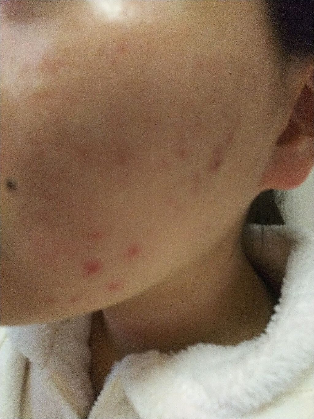 ゆき on LIPS 「こんにちは、ゆきです。ニキビ治療日記2回目です。デュアックを使..」(2枚目)