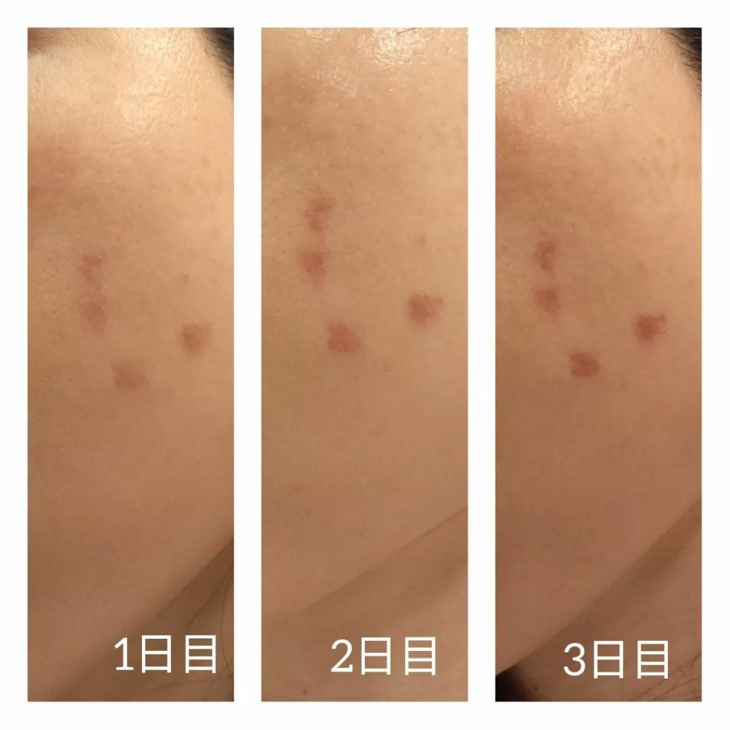 あにゃにゃ♡フォロバ100♡ on LIPS 「5月にしたピコスポット🍅※最後の写真のみ1月した別箇所※今回は..」(3枚目)