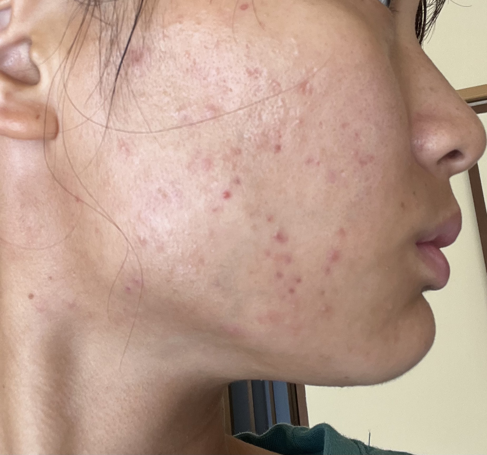 潤浸保湿 化粧水 II しっとり/キュレル/化粧水を使ったクチコミ（1枚目）