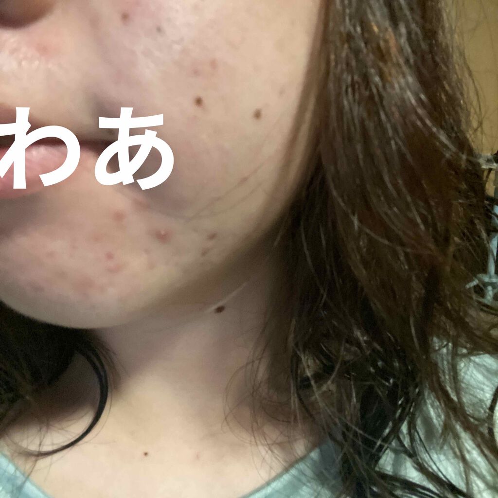 あお on LIPS 「私の肌は混合肌で敏感肌です😖鼻の上に大きなニキビが、、、😭口周..」(4枚目)