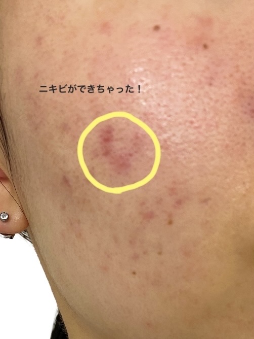 クロロマイセチン軟膏2%A(医薬品)/クロマイ/その他を使ったクチコミ（1枚目）