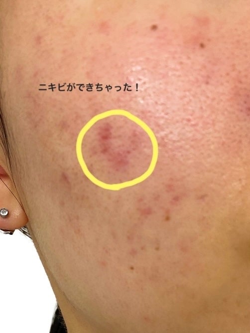 クロロマイセチン軟膏2%A(医薬品)/クロマイ/その他を使ったクチコミ(1枚目)