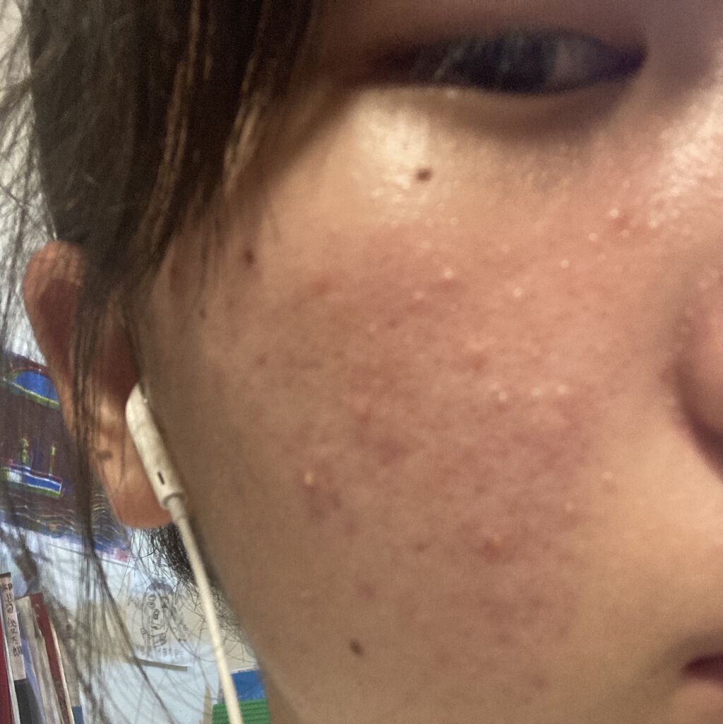 薬用 しみ 集中対策 美容液/メラノCC/美容液を使ったクチコミ（2枚目）