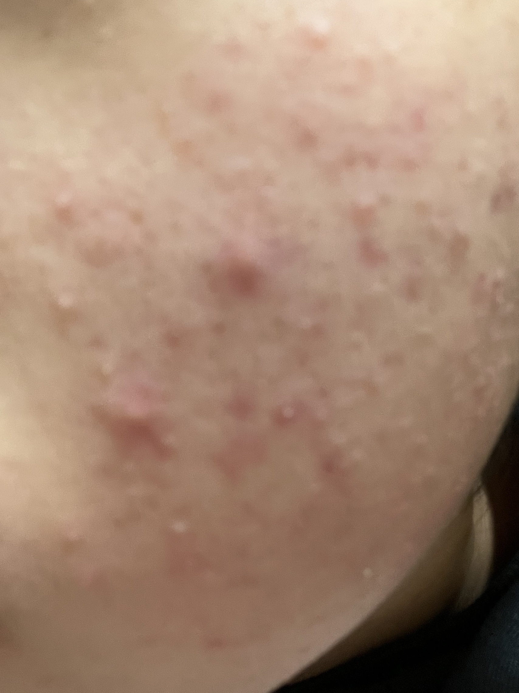 ニキビ治療薬(医薬品)/メンソレータム アクネス/その他を使ったクチコミ（2枚目）