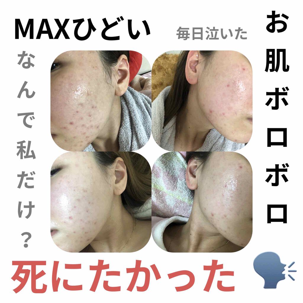 ディフェリンゲル0.1% /マルホ株式会社/その他を使ったクチコミ（1枚目）