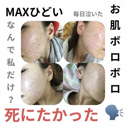 ディフェリンゲル0.1% /マルホ株式会社/その他を使ったクチコミ(1枚目)