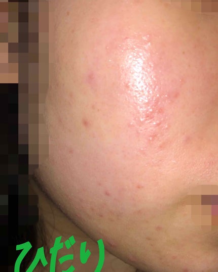 薬用 しみ 集中対策 美容液/メラノCC/美容液を使ったクチコミ(2枚目)