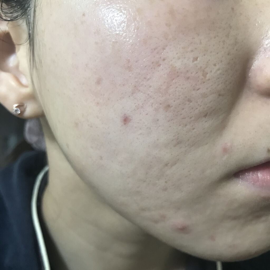 ゼロスポットパッチ/Today’s Cosme/にきびパッチを使ったクチコミ（1枚目）