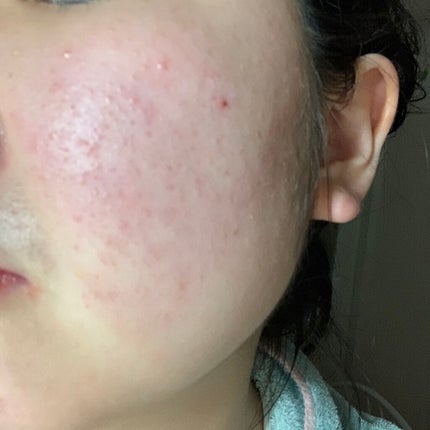 A アクネローション/NOV/化粧水を使ったクチコミ(2枚目)