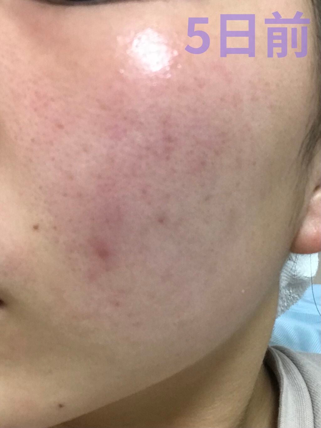 ペアアクネクリームW(医薬品)/ペア/その他を使ったクチコミ(2枚目)