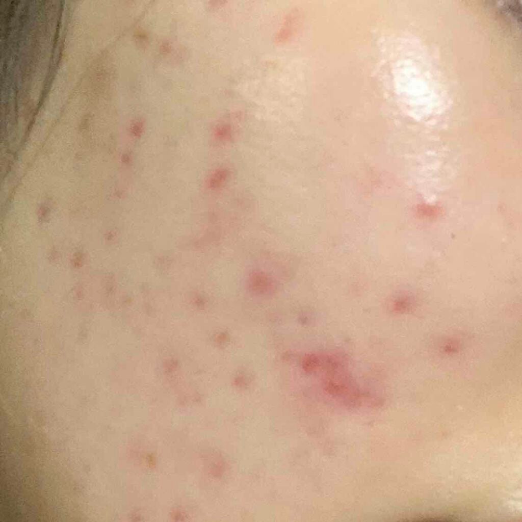 colorful_gloss_bu0p on LIPS 「教えてください(;ᯅ;`)ニキビ跡の治し方ニキビ跡の赤みを治療..」(1枚目)