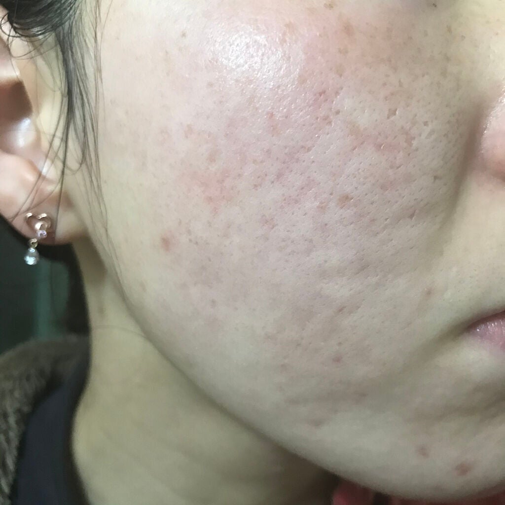 Amino Acid+B5/The Ordinary/美容液を使ったクチコミ(1枚目)