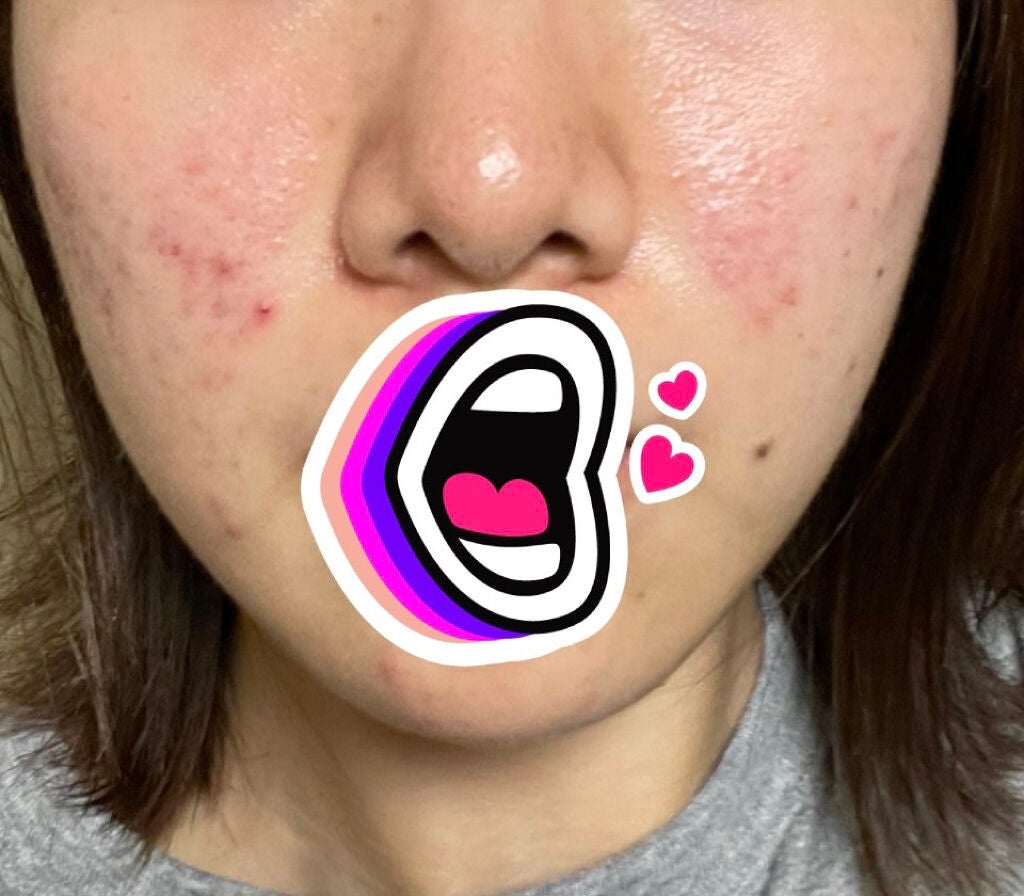 オードムーゲ 薬用ローション(ふきとり化粧水)/オードムーゲ/拭き取り化粧水を使ったクチコミ(1枚目)