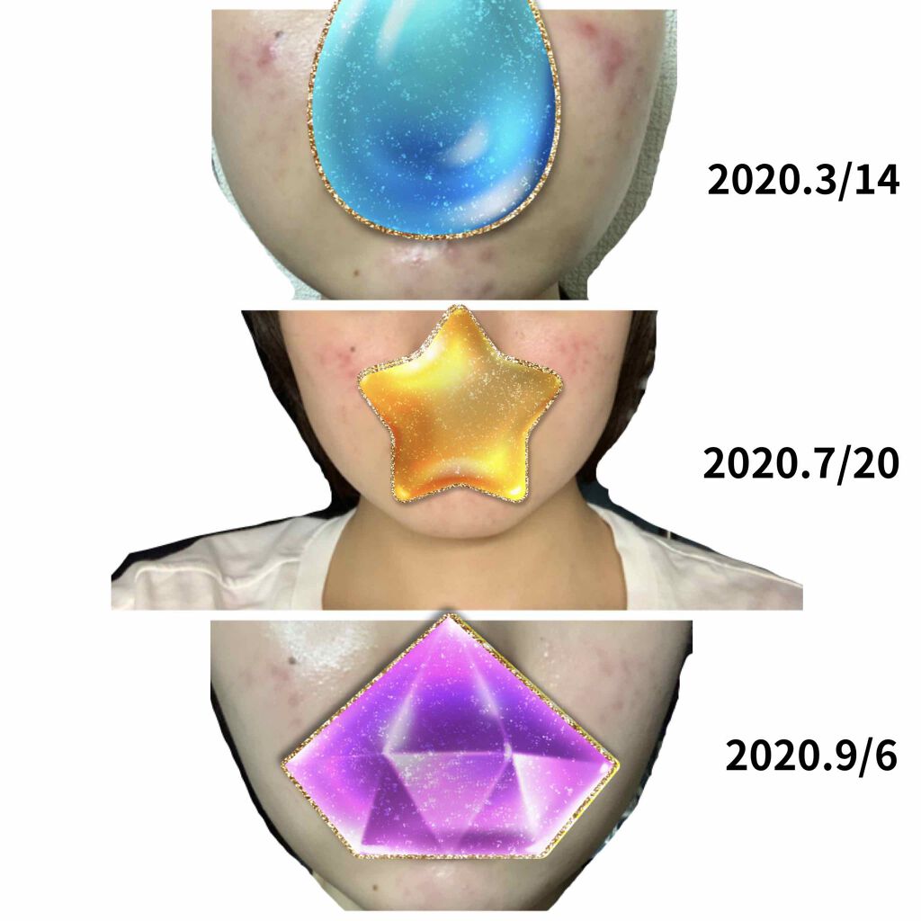 ベピオゲル/マルホ株式会社/その他を使ったクチコミ（2枚目）