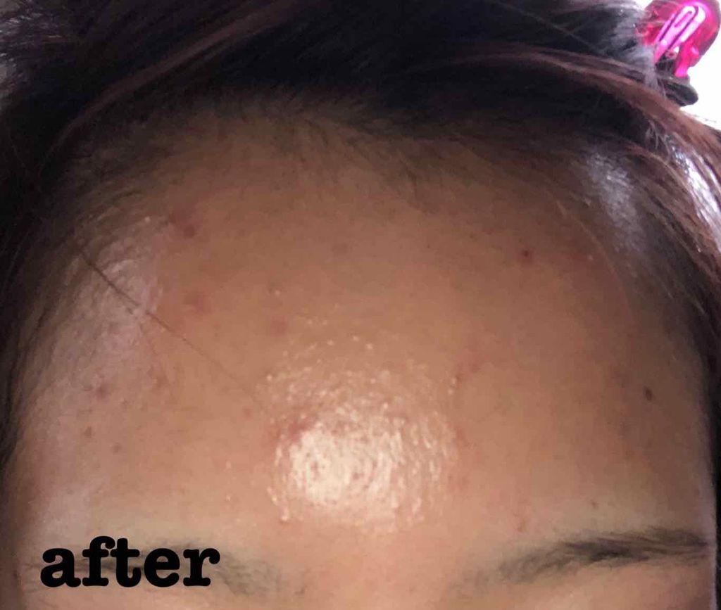 ペアアクネクリームW(医薬品)/ペア/その他を使ったクチコミ（3枚目）