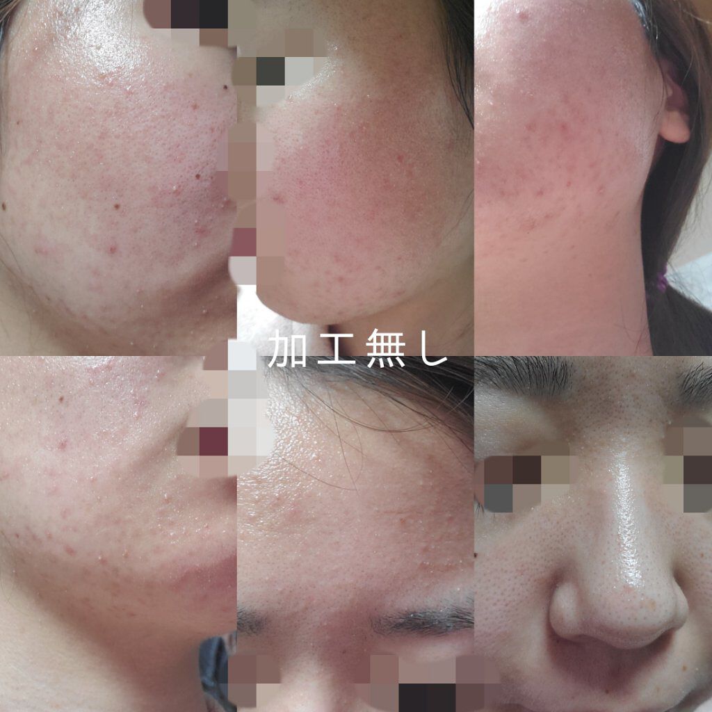 オードムーゲ 薬用ローション（ふきとり化粧水）/オードムーゲ/拭き取り化粧水を使ったクチコミ（2枚目）