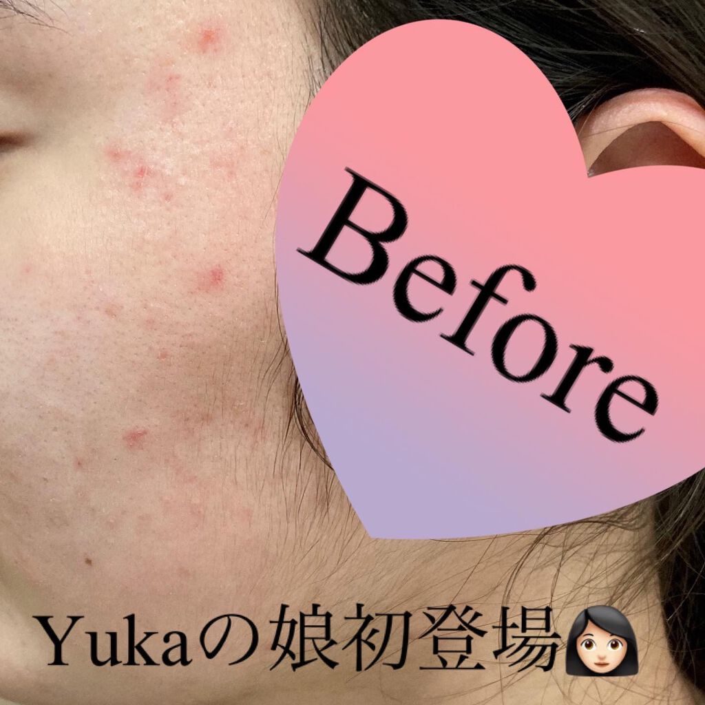 ドクダミ 77 スージングトナー/Anua/化粧水を使ったクチコミ(9枚目)