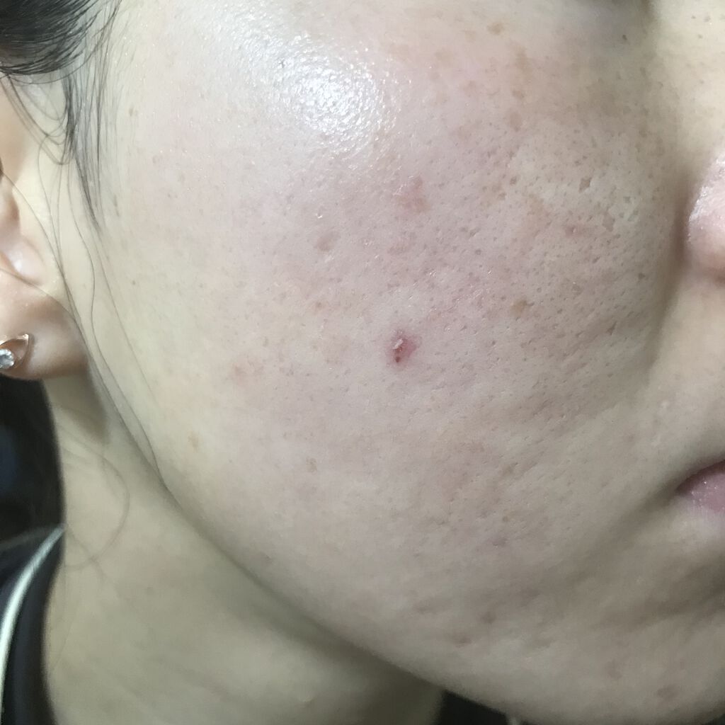 レチノールA 1% アドバンスドリバイタリゼーションクリーム/Life-flo/フェイスクリームを使ったクチコミ（1枚目）